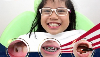 Cấy ghép răng IMPLANT ALL ON 4, 6