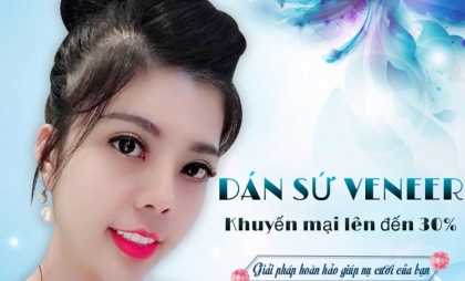 DÁN SỨ VENEER- ƯU ĐÃI LÊN ĐẾN 30%