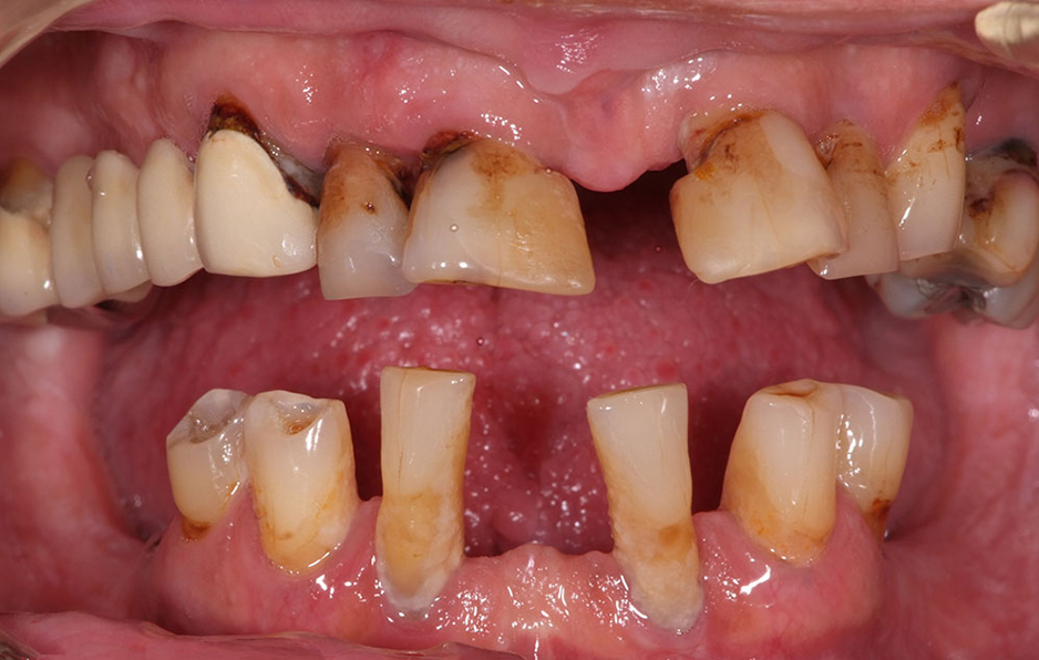 Răng bị viêm nha chu