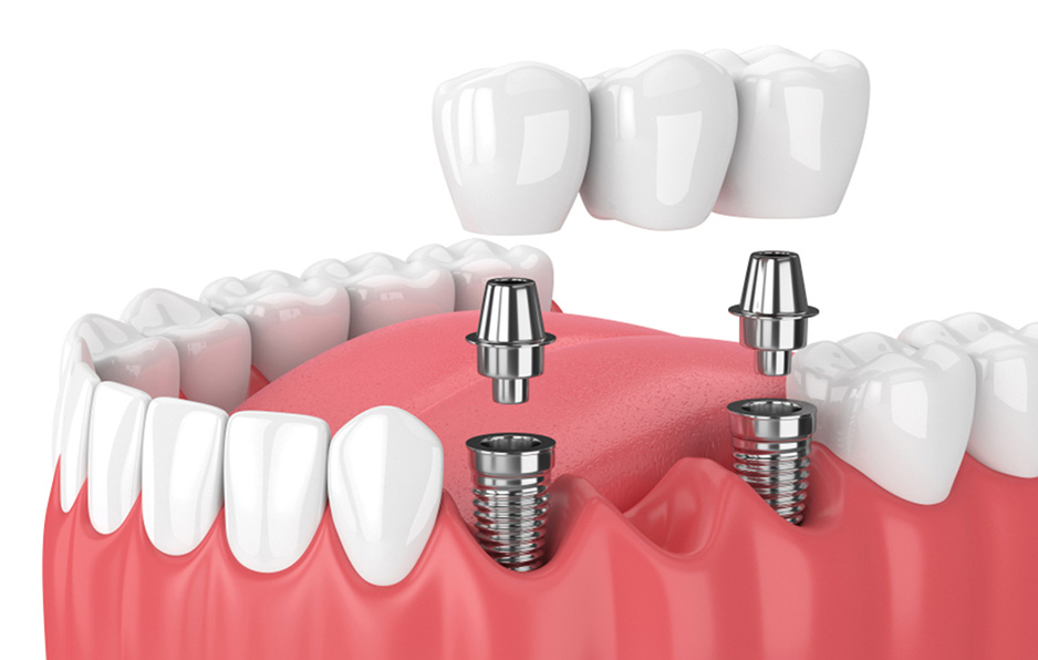Phương pháp cấy ghép Implant